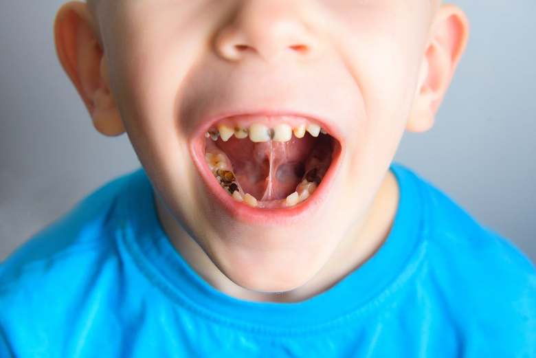 Сколько молочных зубов у детей