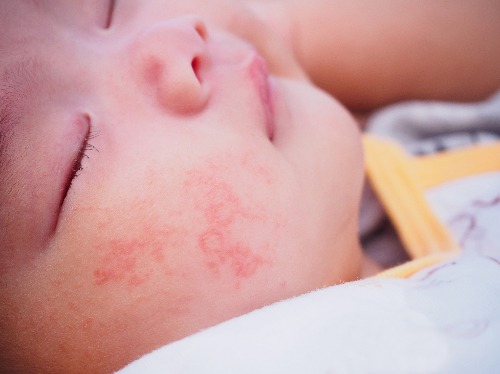 Симптомы атопического дерматита у детей
