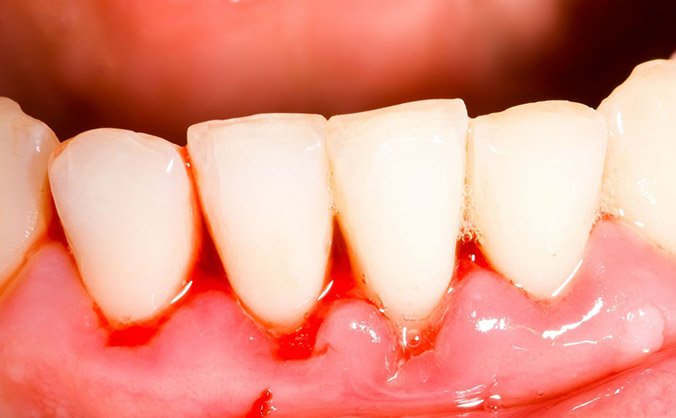 Может ли появиться гингивит, если у ребенка еще нет зубов?